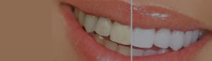 how much is teeth whitening Canada