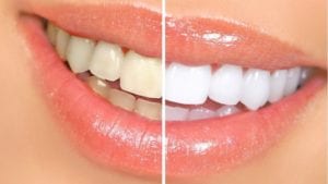 professional teeth whitening before and after