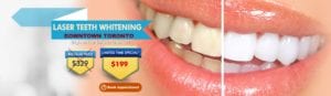 Laser Teeth Whitening TORONTO - $329 $199