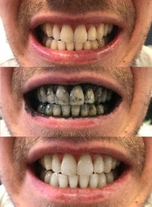 Mr. Black Charcoal Teeth Whitening Powder before & after