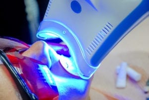 Adult female receiving teeth whitening procedure