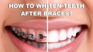 whitening teeeth from braces removal 2