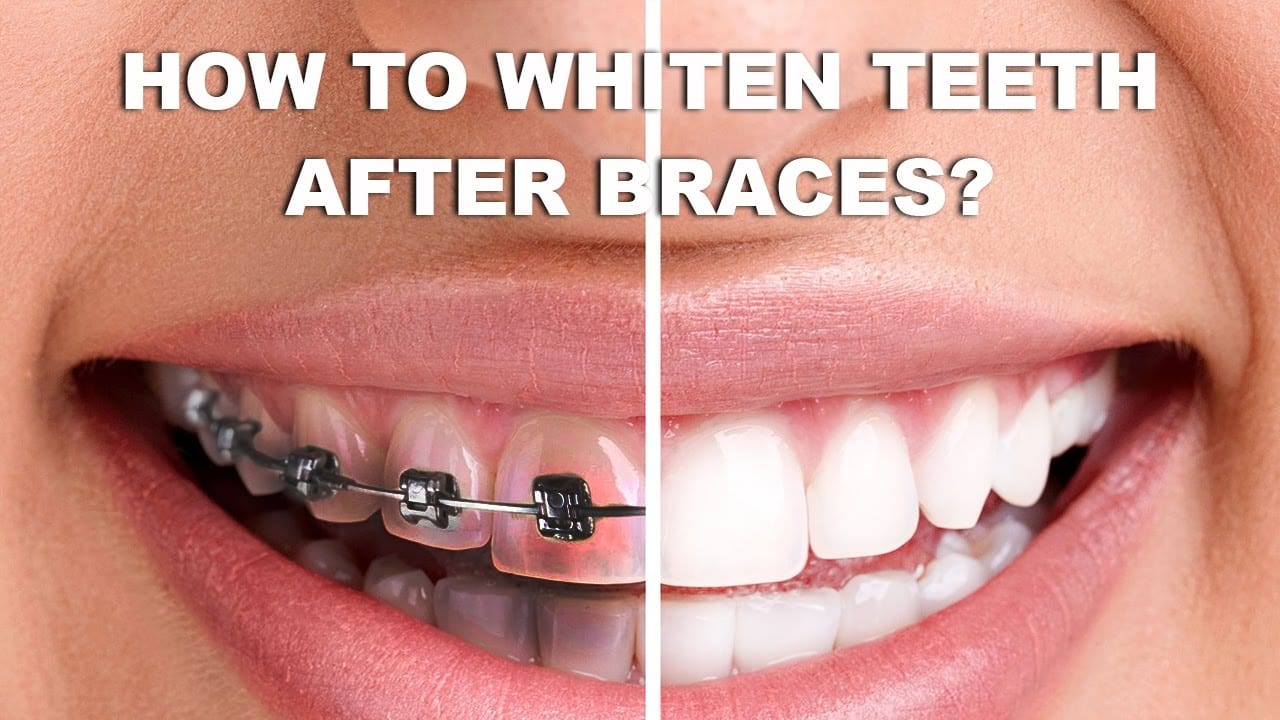 How to get white spots off teeth