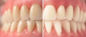 Extrinsic Teeth Stains vs Intrinsic Teeth Stains