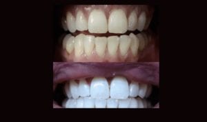 Is Professional Laser Teeth Whitening In Toronto Downtown, Toronto Midtown, Richmond Hill, Danforth, Woodbridge, Vaughan and Brampton For you