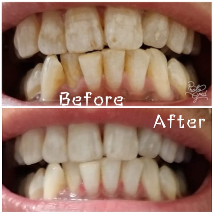 Teeth whitening before and after
