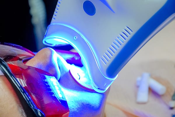 laser teeth whitening