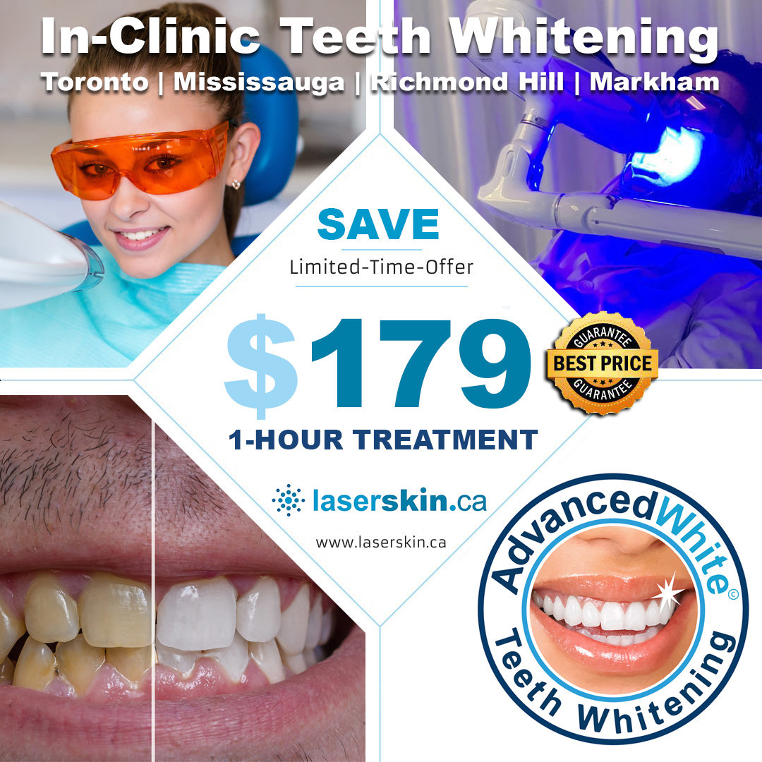 Teeth-Whitening-Toronto ON
