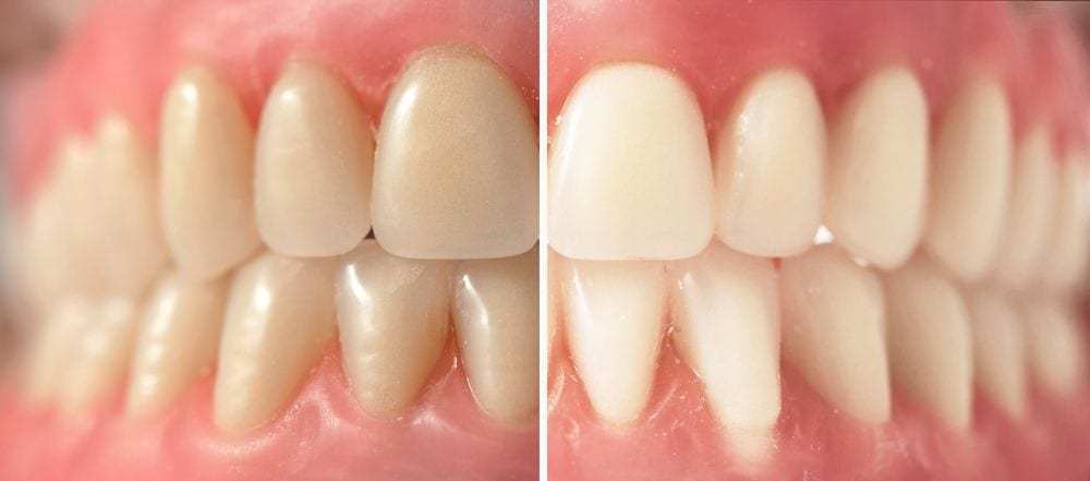 extrinsic teeth stains vs intrinisc teeth stains - Advanced White Teeth Whitening