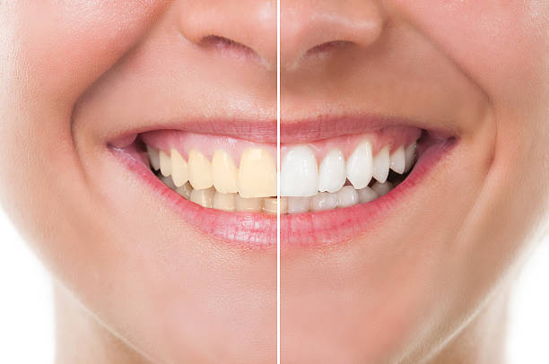 teeth whitening cost Toronto