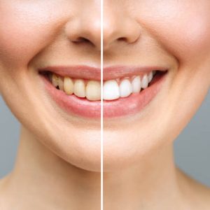 Teeth-Whitening-Toronto