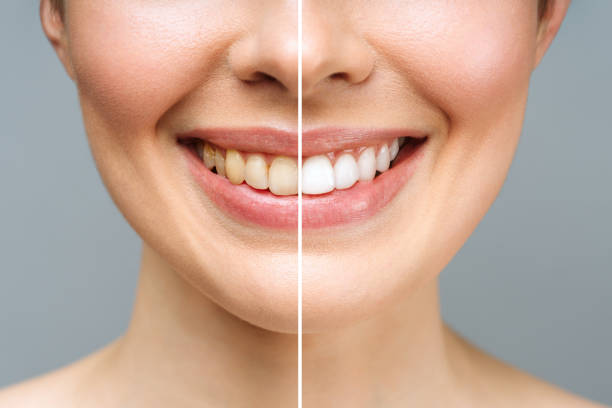 Teeth-Whitening-Toronto