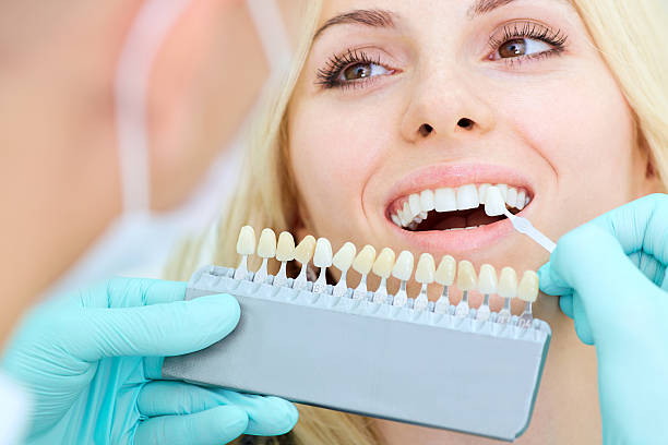 professional teeth whitening Toronto - lazer teeth whitening - laser teeth whitening