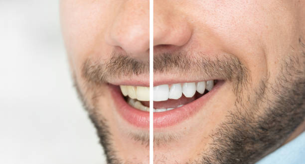 teeth whitening Winnipeg - Advanced White Winnipeg